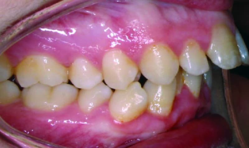 Adult Orthodontic Protrusion